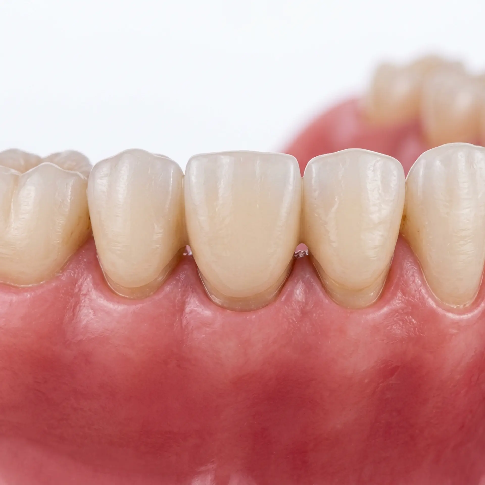 Replacement of Missing Teeth